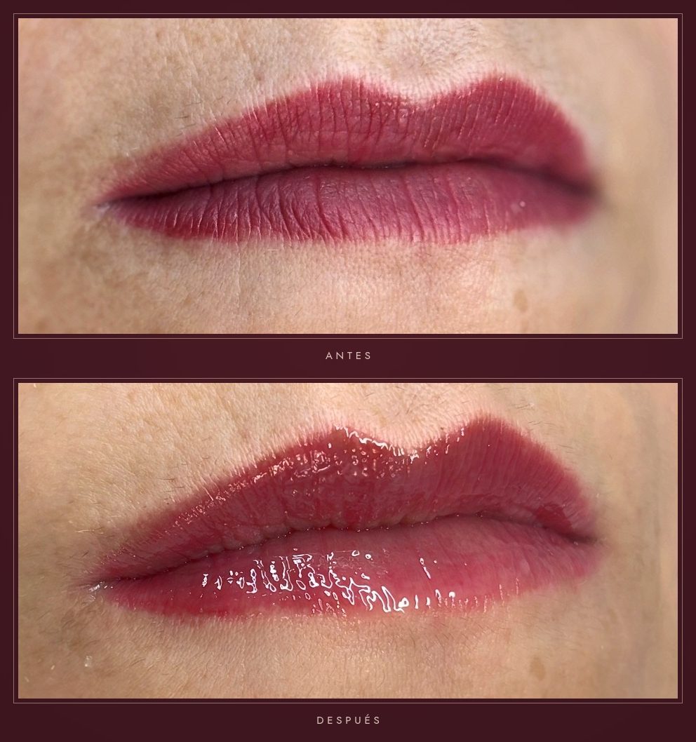Antes y después de un tratamiento Hydralips en labios en Badalona – Bellagea Studio