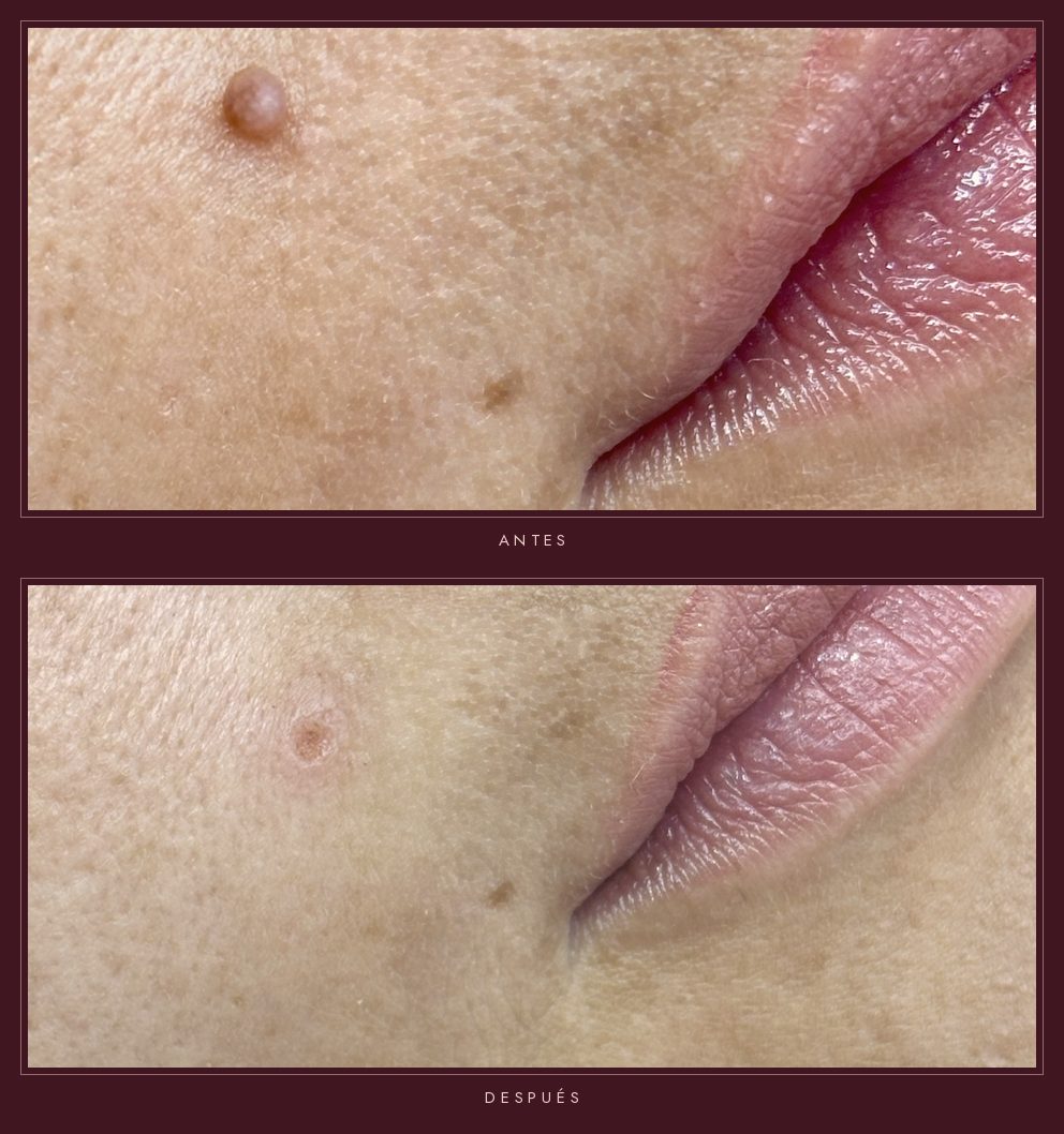 Antes y después de la eliminación de un acrocordón junto al labio con Plasmapen en Badalona – Bellagea Studio