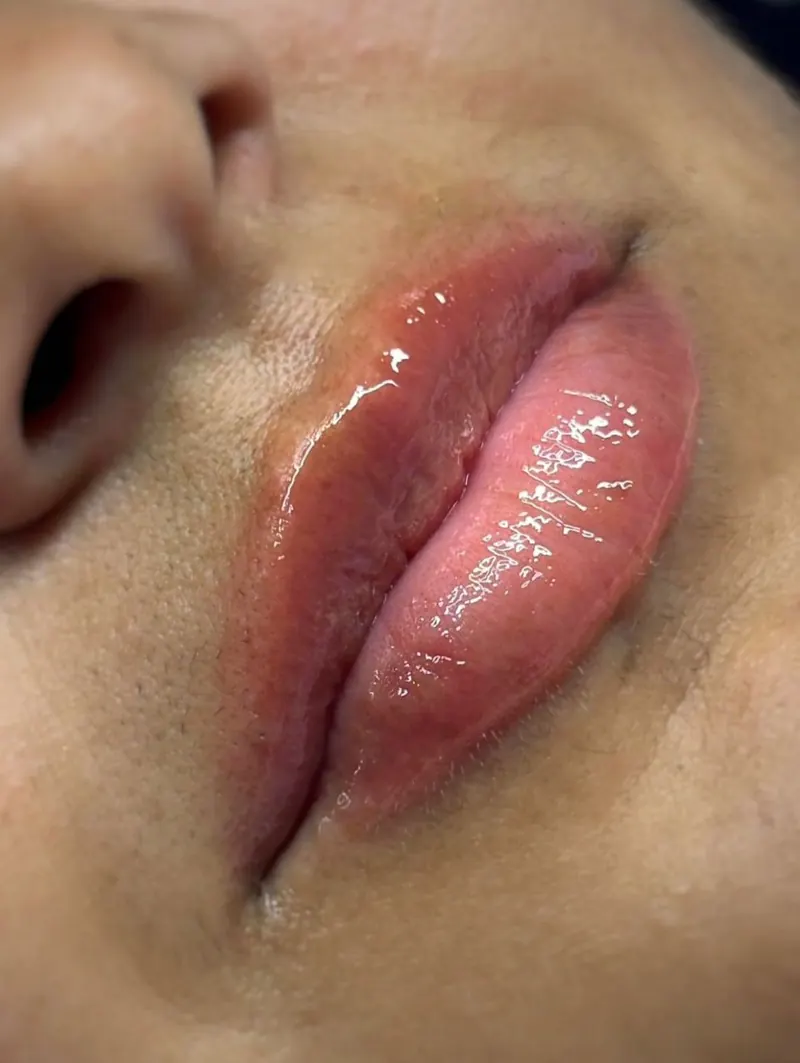 Labios tras un tratamiento Hydralips con dermapen, Bellagea Studio